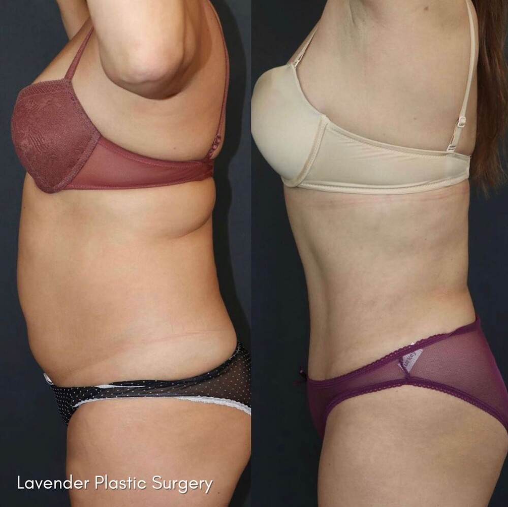 Before and After Result